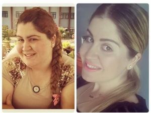 İzmirli Sinem Tüp Mide Ameliyatıyla 55 Kilo Verdi