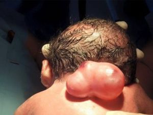 Omuriliği Dışarıda Doğan Bebek, Doğumundan 8 Saat Sonra Ameliyat Edildi