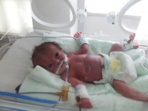 19 Günlük İkiz Bebekleri Ölüm Ayırdı