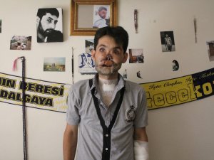 Yüzünde Tüfek Fişeği Patlayan Ahmet İlk Ameliyatını Oldu