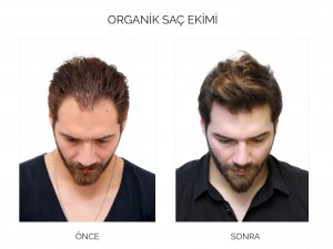 Depresyondaki Saçlara Organik Çözüm