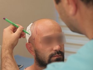 Saç Ekiminde Saç Çizgisine Dikkat