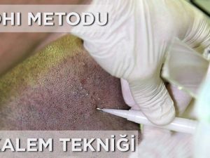 Saç Ekiminde Yeni Teknik Kalem Tekniğiyle Saç Ekimi