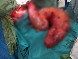 Karnından otomobil lastiği büyüklüğünde tıkanmış bağırsak çıkarıldı