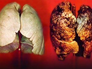 Sinsi gelişen hastalık: Akciğer Kanseri