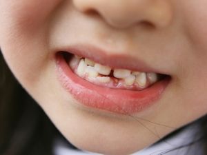 ‘Diş ayrıklığı 16 yaş sonrasında anormal’