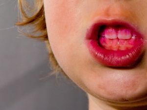 Balıbey ‘Diş Lekelerinde Çözüm Kişiye Özel Olmalı’