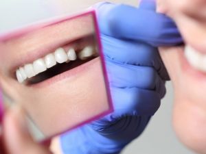 Diş çekmek yerine kanal tedavisi