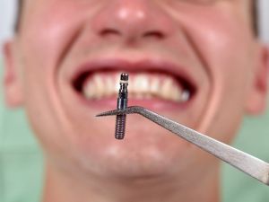 Yetersiz hijyen implant kaybına yol açabilir