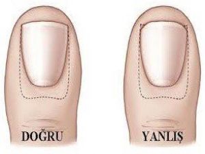 Tırnak batmasında uygulanan yanlış yöntemlere dikkat