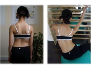 Skolyoz tedavisinde geç kalmayın