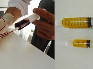 Diz kireçlenmesinde PRP ile kök hücre tedavisi karşılaştırması