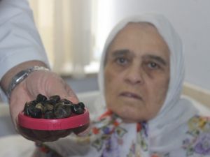 Safra kesesinden çıkan taşlar doktorları bile şaşkına çevirdi