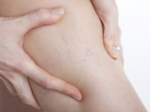 Hayat kalitesini düşüren sinsi düşman; varis ve tedavi yöntemleri