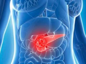 Pankreas kanserinde erken teşhis önemli