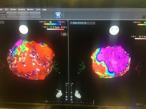 Kalp ritim bozukluklarında yaşam boyu ilaç kullanımına son!