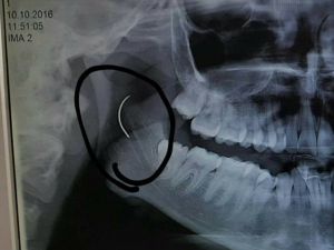 Boğazında unutulan ameliyat iğnesi 18 yıl sonra alındı