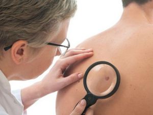 Cilt Kanserinden korunmak için ben haritalama ve yılda bir kez kontrol şart!