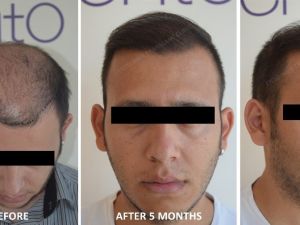 Saç ekiminden sonra bunları asla yapmayın