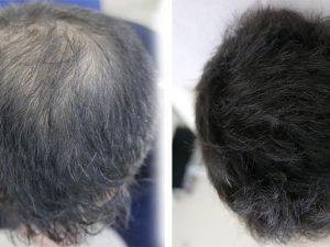 Saç nakli tarihe karışıyor