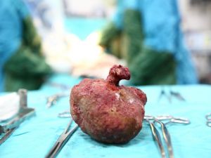 Böbreğinden 12 santimetre çapında taş çıktı