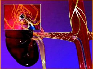 “Renal Denervasyon Tedavisi” hastalara umut oluyor