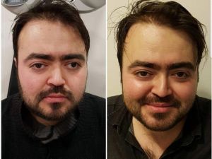 Sevgilisinin gözlerine bakabilmek için ameliyat oldu