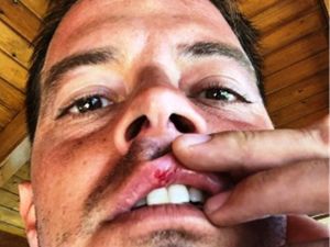 Alp Kırşan tatilde motosikletiyle kaza yaptı