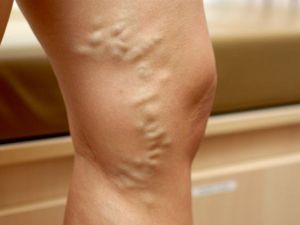 Varisten kurtulmak mümkün