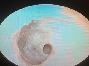 Kulak zarındaki delik, Salihli’de onarıldı