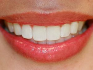 Etkileyici ve doğal gülüşün sırrı