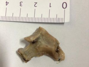 Yemek borusundan 3 santimetrelik kemik çıkarıldı