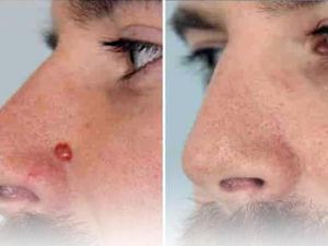 Ameliyatsız ben tedavisi