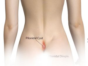 Mikrosinüsektomi yöntemiyle kıl dönmesi tedavisi