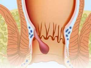 Ameliyatsız Hemoroid tedavisi