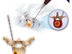 Kanser hastalarına müjde: Artık cerrahi müdahaleye gerek kalmayacak