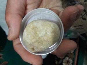 Mesanesinden 300 gram ağırlığında taş çıktı