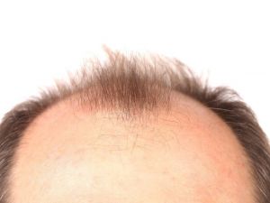 “Kullandığınız ilaçlar saçlarınızın dökülme nedeni olabilir”