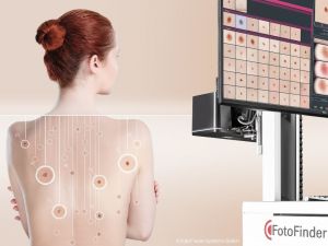 Cilt kanserini erken teşhis için yeni nesil sistemler