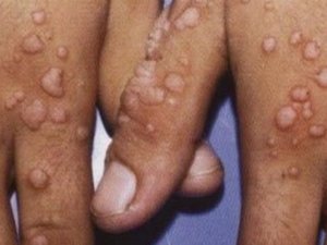 Siğil oluşumu nasıl engellenebilir hakkında bilgi