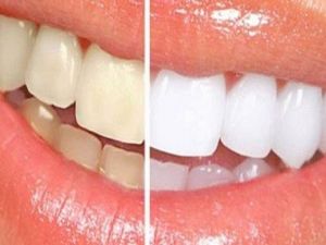 Dişlerde renk değişimine dikkat