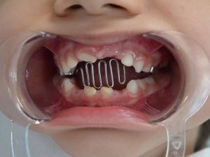 Parmak emme alışkanlığı rahatsızlıklara davetiye çıkartıyor