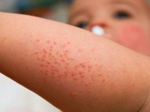 Sıcak havalarda çocuklarda isiliğe dikkat