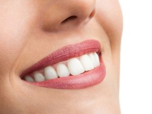 Gülüş tasarımında bunlara dikkat