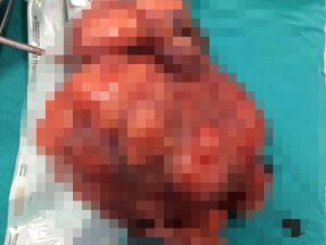 Kasık ağrısı şikayetiyle geldi, karnından 2 kg’lık ur çıktı