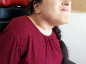 26 yaşındaki engelli hastanın çenesinin altından 38 cm büyüklüğünde tümör çıkarıldı