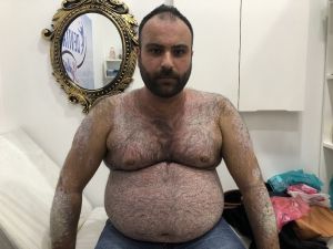 Tüm vücudunu sedef saran hasta derdine Ankara’da çare arıyor