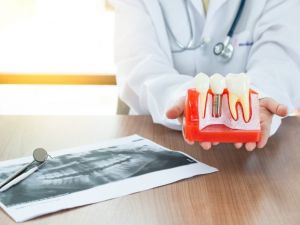 Finansman kolaylıklarıyla implant uygulamalarına talep artıyor