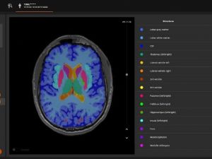 Yapay zeka MR ile birleşti teşhiste umut oldu