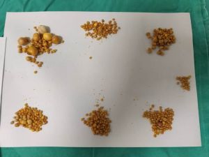 Safra kesesinden binin üzerinde taş çıkarıldı